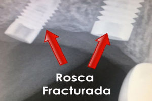 RoscaFracturada