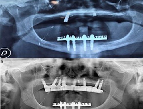 Caso con gran discrepancia maxilo-mandibular con la sistemática Asatim: Prótesis sellado cemento doblemente atornillada.